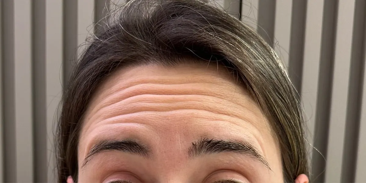 Antes botox