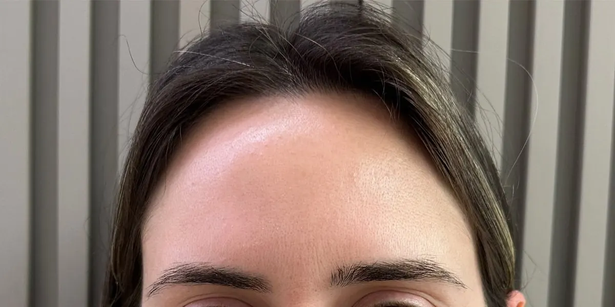 Depois botox
