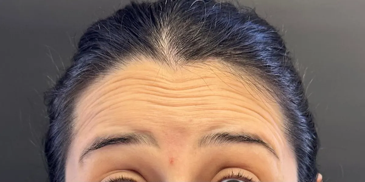 Antes botox