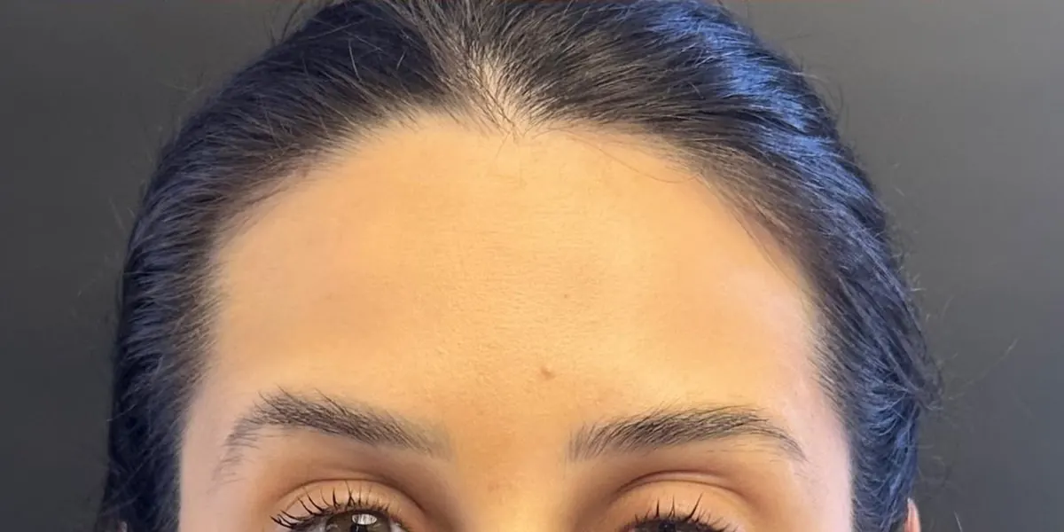 Depois botox