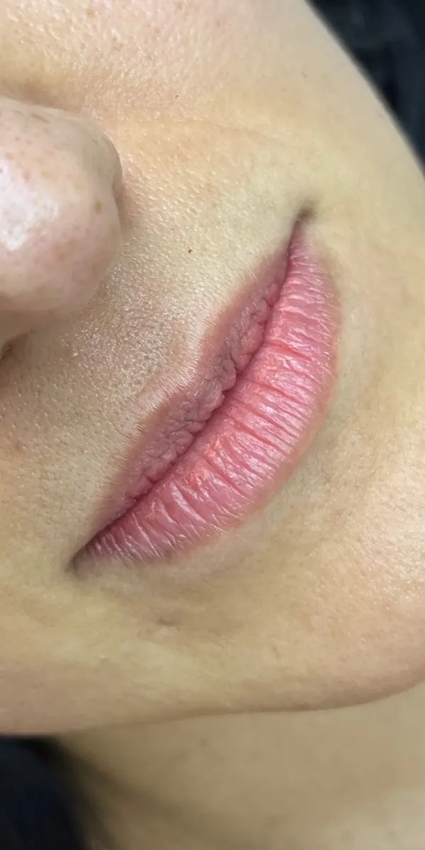 Antes preenchimento labial