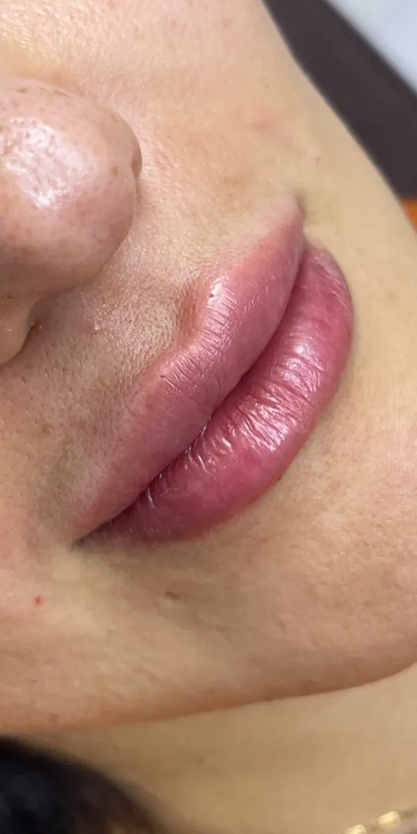 Depois preenchimento labial