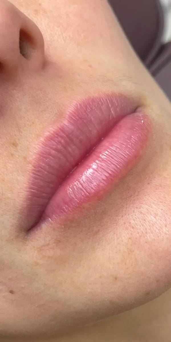 Antes preenchimento labial