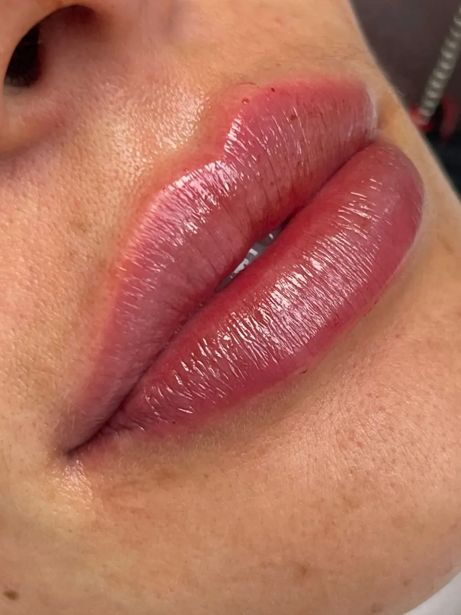 Depois preenchimento labial